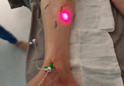 Cirurgia de Varizes a Laser em Sorocaba